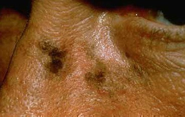 What causes brown skin spots to turn red?